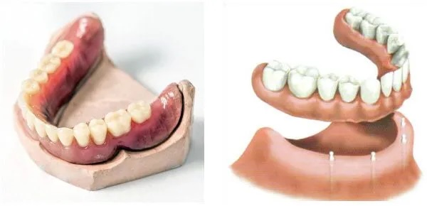 Dentures