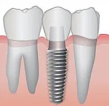 Implants