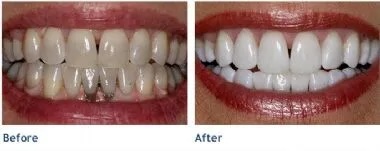 whitening2