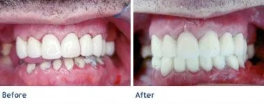 smile makeover1