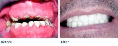 smile makeover2