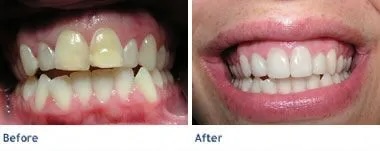 smile makeover3